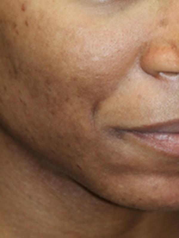 Skin Restoration Case 6133, After Treatment, Female Patient, Set 3