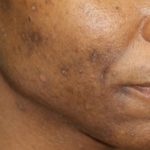 Skin Restoration Case 6133, Before Treatment, Female Patient, Thumbnail 3