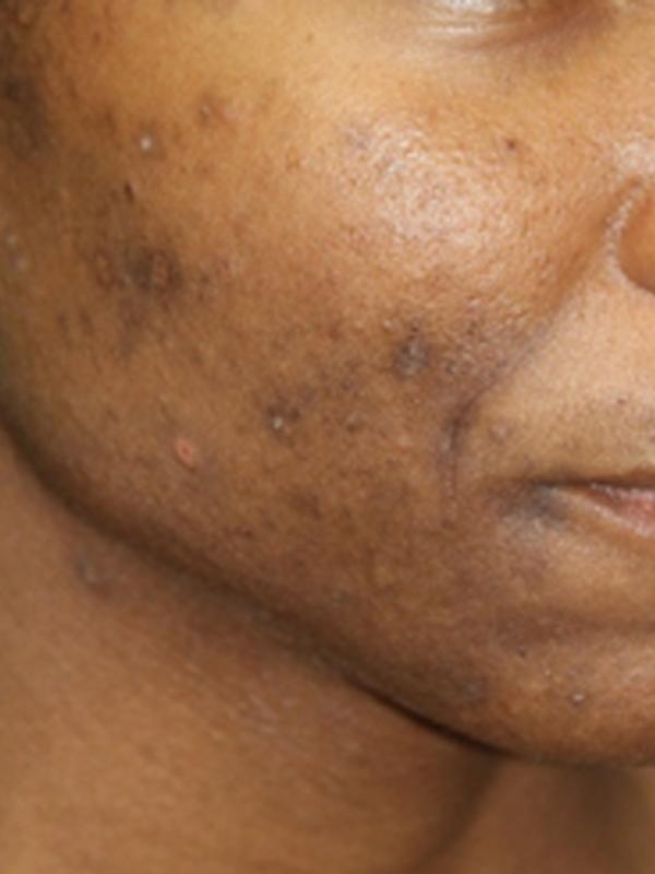 Skin Restoration Case 6133, Before Treatment, Female Patient, Set 3