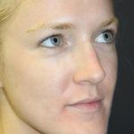 Skin Restoration Case 6134, After Treatment, Female Patient, Thumbnail 1