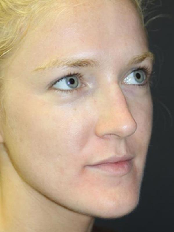 Skin Restoration Case 6134, After Treatment, Female Patient, Set 1