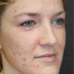 Skin Restoration Case 6134, Before Treatment, Female Patient, Thumbnail 1