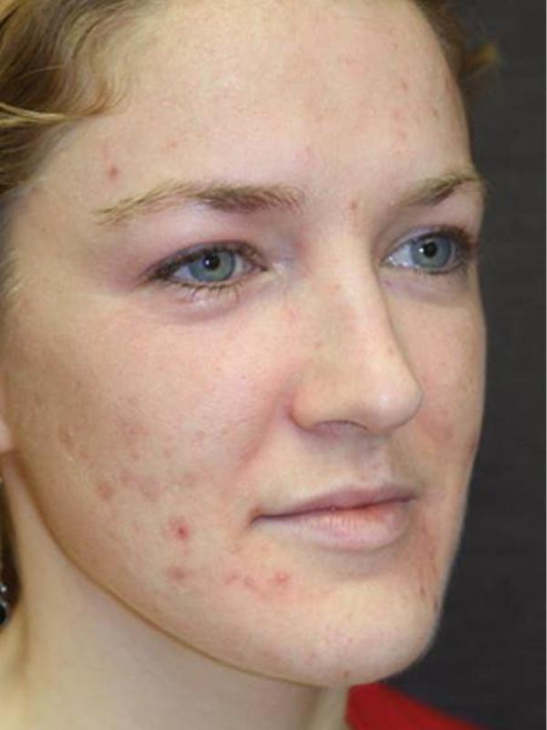 Skin Restoration Case 6134, Before Treatment, Female Patient, Set 1