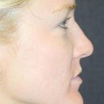Skin Restoration Case 6134, After Treatment, Female Patient, Thumbnail 2