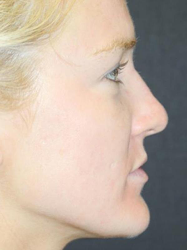 Skin Restoration Case 6134, After Treatment, Female Patient, Set 2