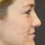 Skin Restoration Case 6134, Before Treatment, Female Patient, Thumbnail 2
