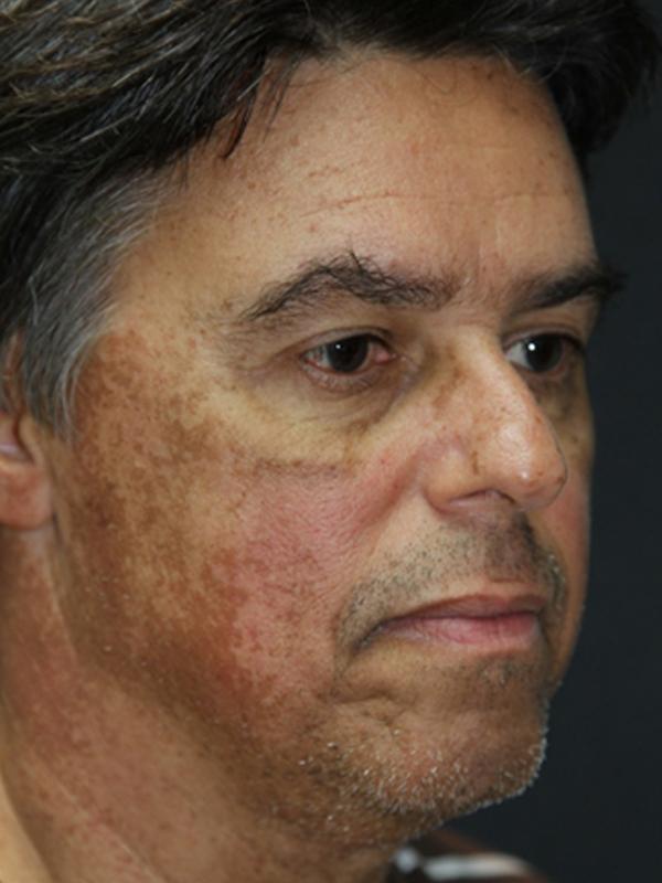 Main Photo Gallery, Case 6137, Before Treatment 