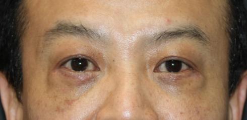 Eyelid Lift After Photo