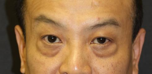 Eyelid Lift Before Photo