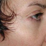 Eyelid and Brow Enhancement Case 6730, After Treatment, Female Patient, Thumbnail 1