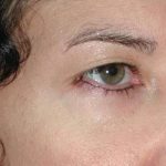 Eyelid and Brow Enhancement Case 6730, Before Treatment, Female Patient, Thumbnail 1