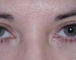 Eyelid and Brow Enhancement Case 6730, After Treatment, Female Patient, Thumbnail 2