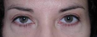 Eyelid and Brow Enhancement Case 6730, After Treatment, Female Patient, Set 2