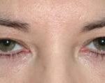 Eyelid and Brow Enhancement Case 6730, Before Treatment, Female Patient, Thumbnail 2
