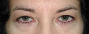Eyelid and Brow Enhancement Case 6730, Before Treatment, Female Patient, Set 2