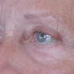 Eyelid and Brow Enhancement Case 6731, After Treatment, Female Patient, Thumbnail 1