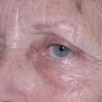 Eyelid and Brow Enhancement Case 6731, Before Treatment, Female Patient, Thumbnail 1