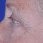 Eyelid and Brow Enhancement Case 6731, After Treatment, Female Patient, Thumbnail 2