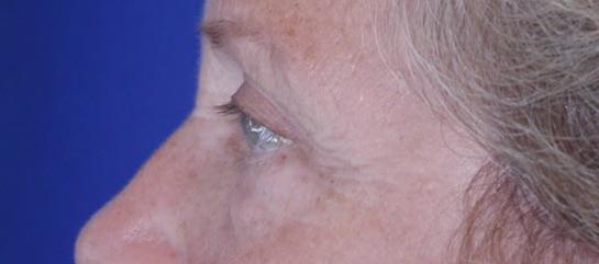 Eyelid and Brow Enhancement Case 6731, After Treatment, Female Patient, Set 2