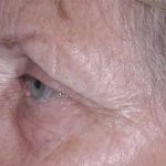 Eyelid and Brow Enhancement Case 6731, Before Treatment, Female Patient, Thumbnail 2