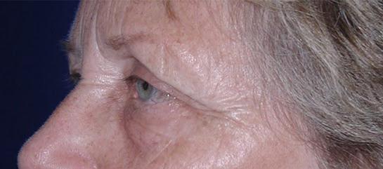 Eyelid and Brow Enhancement Case 6731, Before Treatment, Female Patient, Set 2