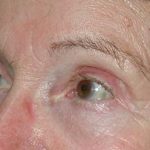 Eyelid and Brow Enhancement Case 6732, After Treatment, Female Patient, Thumbnail 1