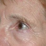 Eyelid and Brow Enhancement Case 6732, Before Treatment, Female Patient, Thumbnail 1
