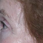 Eyelid and Brow Enhancement Case 6732, After Treatment, Female Patient, Thumbnail 2