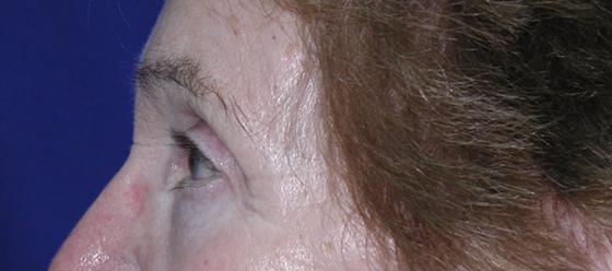 Eyelid and Brow Enhancement Case 6732, After Treatment, Female Patient, Set 2