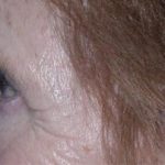 Eyelid and Brow Enhancement Case 6732, Before Treatment, Female Patient, Thumbnail 2