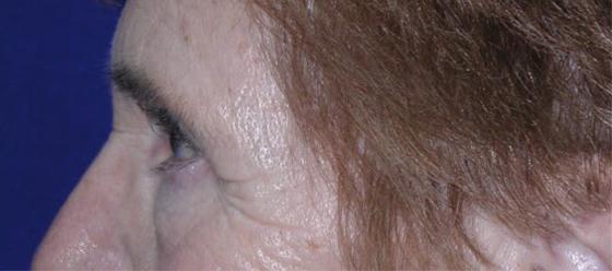 Eyelid and Brow Enhancement Case 6732, Before Treatment, Female Patient, Set 2