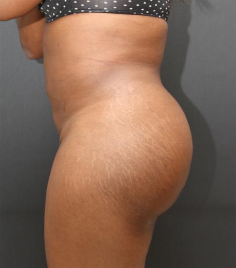 Jersey Shore Butt Lift Case 6745, After Treatment, Female Patient, Set 2