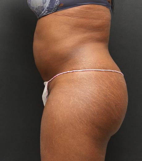 Jersey Shore Butt Lift Case 6745, Before Treatment, Female Patient, Set 2
