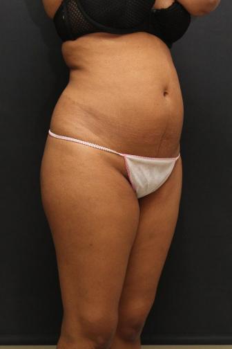 Jersey Shore Butt Lift Case 6746, Before Treatment, Female Patient, Set 2