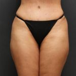 Jersey Shore Butt Lift Case 6747, After Treatment, Female Patient, Thumbnail 1