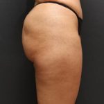 Jersey Shore Butt Lift Case 6747, After Treatment, Female Patient, Thumbnail 3