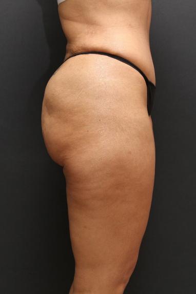 Jersey Shore Butt Lift Case 6747, After Treatment, Female Patient, Set 3
