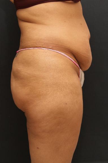 Jersey Shore Butt Lift Case 6747, Before Treatment, Female Patient, Set 3
