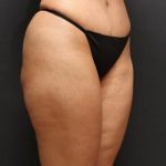 Jersey Shore Butt Lift Case 6747, After Treatment, Female Patient, Thumbnail 2