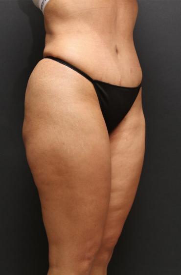 Jersey Shore Butt Lift Case 6747, After Treatment, Female Patient, Set 2