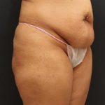 Jersey Shore Butt Lift Case 6747, Before Treatment, Female Patient, Thumbnail 2