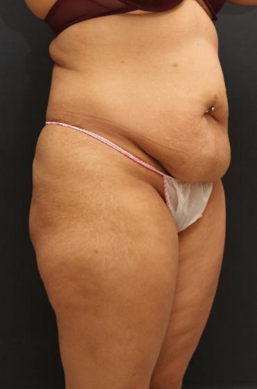 Jersey Shore Butt Lift Case 6747, Before Treatment, Female Patient, Set 2