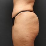 Jersey Shore Butt Lift Case 6747, After Treatment, Female Patient, Thumbnail 4