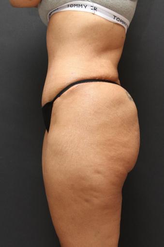 Jersey Shore Butt Lift Case 6747, After Treatment, Female Patient, Set 4