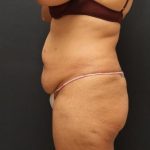 Jersey Shore Butt Lift Case 6747, Before Treatment, Female Patient, Thumbnail 4