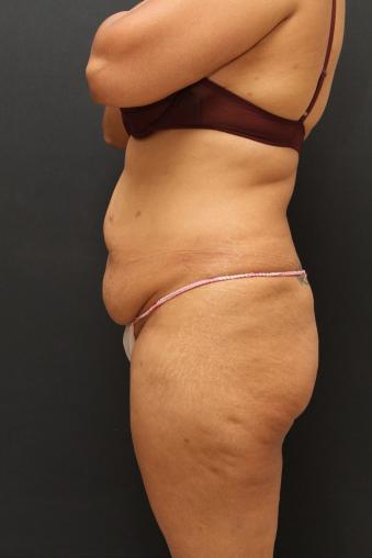 Jersey Shore Butt Lift Case 6747, Before Treatment, Female Patient, Set 4
