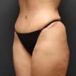 Jersey Shore Butt Lift Case 6747, After Treatment, Female Patient, Thumbnail 5