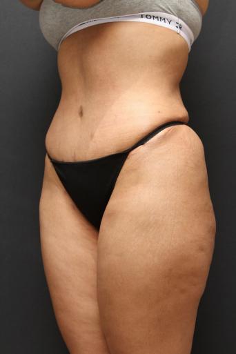 Jersey Shore Butt Lift Case 6747, After Treatment, Female Patient, Set 5