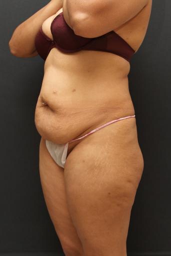 Jersey Shore Butt Lift Case 6747, Before Treatment, Female Patient, Set 5