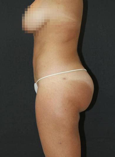 Jersey Shore Butt Lift Case 6748, After Treatment, Female Patient, Set 2